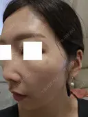 スネコス ミニマムスキンクリニック池袋 DAY 2 サムネイル用