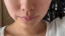 小鼻縮小（非切開） / ボトックス（エラ・小顔） / ボトックス（肩） 新未来クリニック AFTER サムネイル用
