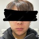 糸リフト / 脂肪吸引（顔） / 脂肪吸引注射（顔） / ヒアルロン酸注入（あご） SEA CLINIC（シークリニック） DAY 5 サムネイル用