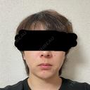 糸リフト / 脂肪吸引（顔） / 脂肪吸引注射（顔） / ヒアルロン酸注入（あご） SEA CLINIC（シークリニック） DAY 15 サムネイル用