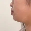 ボトックス（あご） / ヒアルロン酸注入（あご） ルラ美容クリニック 大阪心斎橋院 DAY 0 サムネイル用