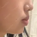 ボトックス（あご） / ヒアルロン酸注入（あご） ルラ美容クリニック 大阪心斎橋院 DAY 0 サムネイル用