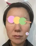 糸リフト Olino美容外科・美容皮膚科 DAY 35 サムネイル用
