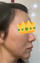糸リフト Olino美容外科・美容皮膚科 DAY 35 サムネイル用