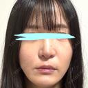 小鼻縮小（切開） / 鼻翼基部形成（貴族手術） 新宿ラクル美容外科クリニック 新宿院 DAY 50 サムネイル用