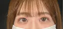 二重埋没 湘南美容クリニック 千葉センシティ院 AFTER サムネイル用