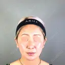 糸リフト / 脂肪吸引（顔） / ジョールファット除去 アリエル美容クリニック 郡山院 DAY 95 サムネイル用