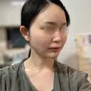 RF（高周波）たるみ治療 Chloe Cheongdam Clinic （クロエチョンダムクリニック） DAY 0 サムネイル用