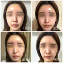 額を丸く / こめかみ形成 / 脂肪注入（額） 湘南美容クリニック 吉祥寺院 AFTER サムネイル用