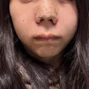 鼻尖形成（切開） / 小鼻縮小（切開） / 軟骨移植 RIVER CLINIC（リバークリニック） DAY 1 サムネイル用