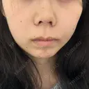 鼻尖形成（切開） / 小鼻縮小（切開） / 軟骨移植 RIVER CLINIC（リバークリニック） DAY 6 サムネイル用