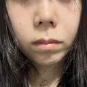 鼻尖形成（切開） / 小鼻縮小（切開） / 軟骨移植 RIVER CLINIC（リバークリニック） DAY 8 サムネイル用