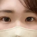 二重埋没 / 上まぶたの脂肪取り / 脂肪溶解注射（顔） TCB東京中央美容外科 前橋院 DAY 8 サムネイル用