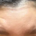 シワ取りボトックス 湘南美容クリニック 新横浜院 AFTER サムネイル用