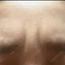 シワ取りボトックス 湘南美容クリニック 新横浜院 DAY 1 サムネイル用