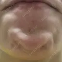 シワ取りボトックス 湘南美容クリニック 新横浜院 DAY 1 サムネイル用