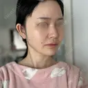 RF（高周波）たるみ治療 Chloe Cheongdam Clinic （クロエチョンダムクリニック） DAY 2 サムネイル用