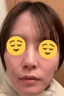 光治療（フォトフェイシャルなど） メディカルアルファクリニック DAY 5 サムネイル用