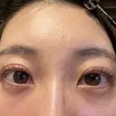 クマ治療 / 下まぶたの脂肪取り APOLLO BEAUTY CLINIC DAY 13 サムネイル用