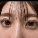 クマ治療 / 下まぶたの脂肪取り APOLLO BEAUTY CLINIC DAY 18 サムネイル用