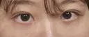 二重埋没 HAAB×DREAM BEAUTY CLINIC 大阪梅田院 AFTER サムネイル用
