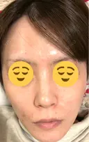 光治療（フォトフェイシャルなど） メディカルアルファクリニック DAY 6 サムネイル用