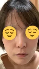 光治療（フォトフェイシャルなど） メディカルアルファクリニック DAY 9 サムネイル用