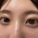 クマ治療 / 下まぶたの脂肪取り APOLLO BEAUTY CLINIC AFTER サムネイル用