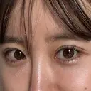 ヒアルロン酸注入（唇） / ヒアルロン酸注入（目の下） ROOTS Clinic DAY 1 サムネイル用