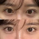 ヒアルロン酸注入（唇） / ヒアルロン酸注入（目の下） ROOTS Clinic AFTER サムネイル用