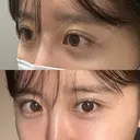 ヒアルロン酸注入（唇） / ヒアルロン酸注入（目の下） ROOTS Clinic DAY 2 サムネイル用