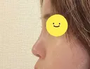小鼻縮小（切開） / その他（鼻） EMMO FACE CLINIC 東京三田院 DAY 10 サムネイル用