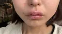 アートメイク（唇） 表参道メディカルクリニック 名古屋院 DAY 23 サムネイル用