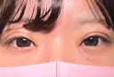 二重埋没 / 目頭切開 HAAB×DREAM BEAUTY CLINIC 大阪梅田院 AFTER サムネイル用