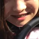 脂肪溶解注射（顔） S Beauty Clinic DAY 82 サムネイル用