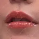 肌ヒアルロン酸注入（たるみ・シワ改善） / ボトックス（口角） / ボトックス（人中） S-Laboクリニック 渋谷院 DAY 1 サムネイル用