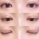 二重切開 / 目頭切開 / 眼瞼下垂（切開） / その他（目元） / 上まぶたの脂肪取り レアート整形外科 DAY 62 サムネイル用