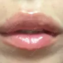 ヒアルロン酸注入（唇） / ヒアルロン酸注入（目の下） KIMI CLINIC 形成・美容外科 DAY 1 サムネイル用