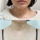 ベビーコラーゲン / シミ取りレーザー / ほくろ・いぼ除去レーザー（首） 渋谷美容外科クリニック 渋谷院 AFTER サムネイル用