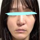 小鼻縮小（切開） / 鼻翼基部形成（貴族手術） 新宿ラクル美容外科クリニック 新宿院 DAY 58 サムネイル用