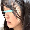 小鼻縮小（切開） / 鼻翼基部形成（貴族手術） 新宿ラクル美容外科クリニック 新宿院 DAY 58 サムネイル用