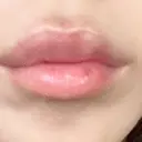 ヒアルロン酸注入（唇） / ヒアルロン酸注入（目の下） KIMI CLINIC 形成・美容外科 DAY 2 サムネイル用