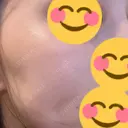 肌育注射（ジュベルックなど） シェリークリニック 福岡院 AFTER サムネイル用