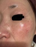 レーザートーニング（美白・肝斑） メディアージュクリニック 名古屋院 DAY 10 サムネイル用
