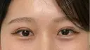 二重埋没 ルラ美容クリニック 神戸院 AFTER サムネイル用