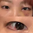 クマ治療 / ヒアルロン酸注入（目の下） PRISM Beauty Clinic 町田院 DAY 5 サムネイル用