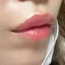 ヒアルロン酸注入（唇） / ヒアルロン酸注入（目の下） KIMI CLINIC 形成・美容外科 DAY 3 サムネイル用