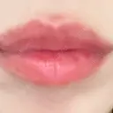 ヒアルロン酸注入（唇） / ヒアルロン酸注入（目の下） KIMI CLINIC 形成・美容外科 DAY 4 サムネイル用
