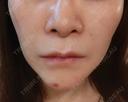 脂肪溶解注射（顔） / ヒアルロン酸注入（鼻翼基部） / ヒアルロン酸注入（ほうれい線） 目白ホワイトクリニック DAY 2 サムネイル用