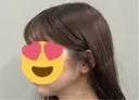 糸リフト / 脂肪吸引（顔） 脂肪吸引ラボトウキョウ DAY 63 サムネイル用